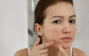 acne facial