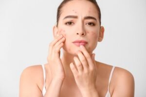 acne on cheeks