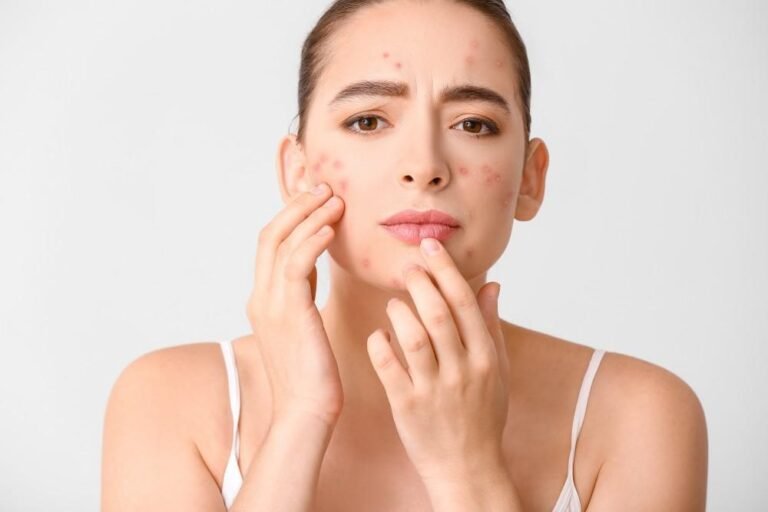 acne on cheeks