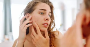 can irritation cause acne