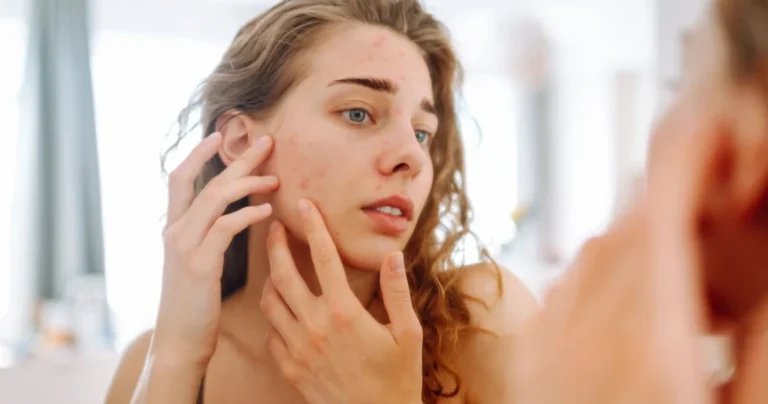 can irritation cause acne