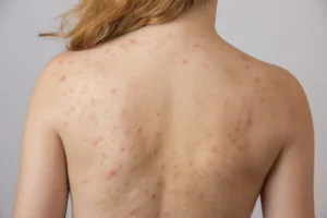 how can you get rid of body acne