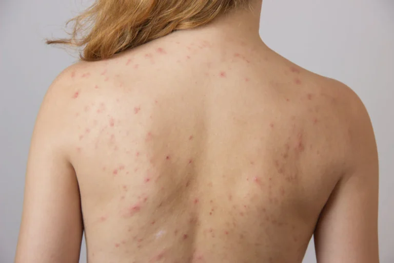 how can you get rid of body acne