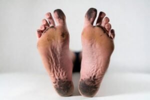 black patches on bottom of feet