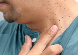 are skin tags contagious